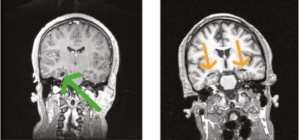 perirhinal cortex MRI scans